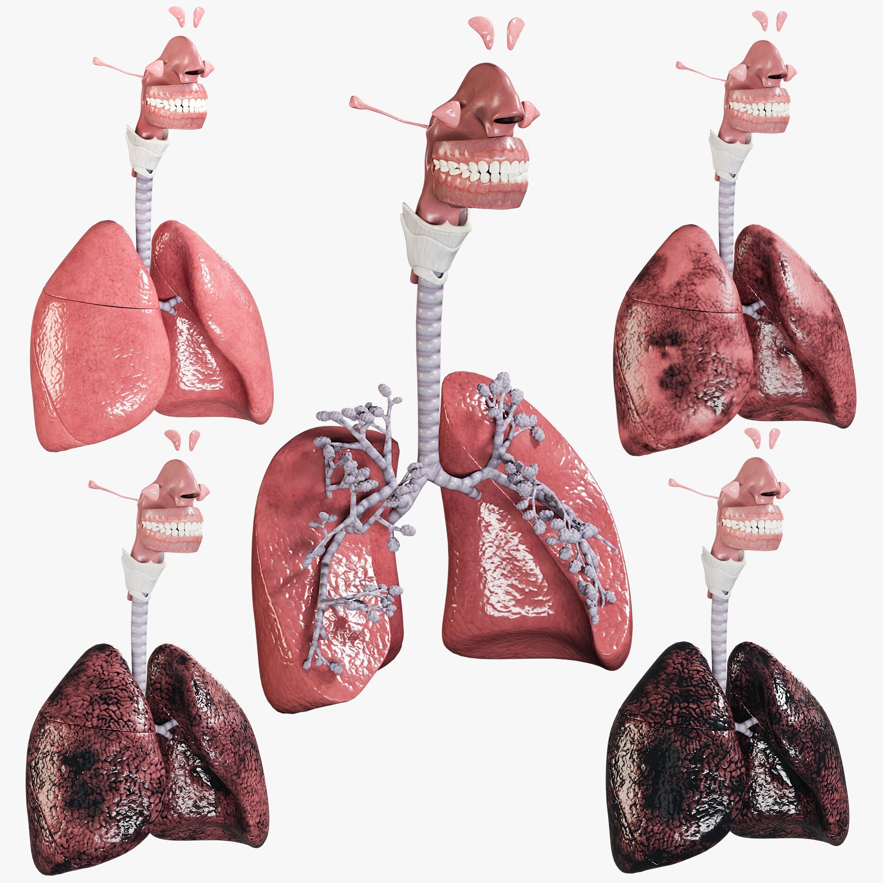 Respiratory System Collection - Smokers Lungs Stages