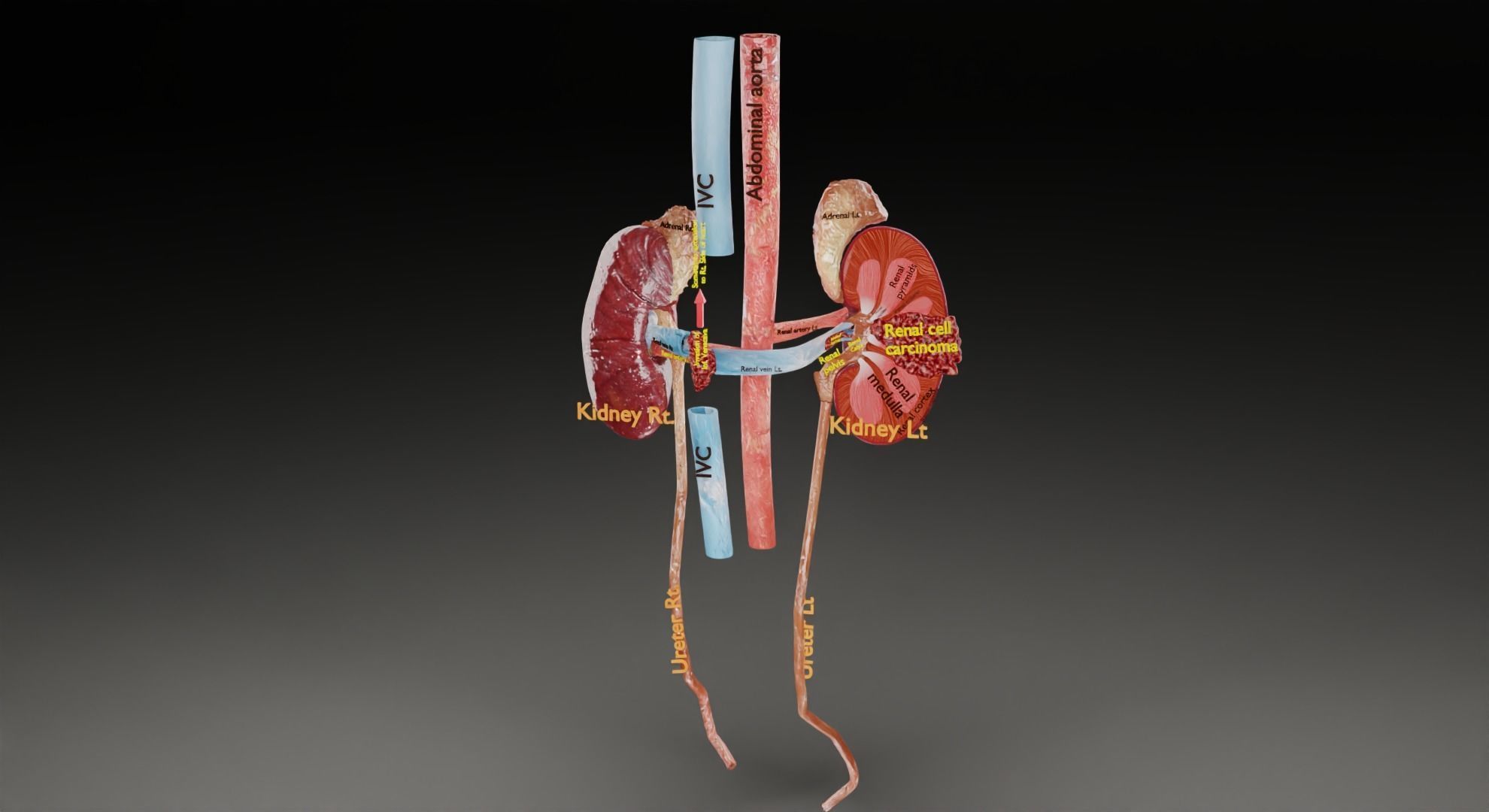 Kidney Cell Model Renal cell carcinoma 3D model animated | CGTrader