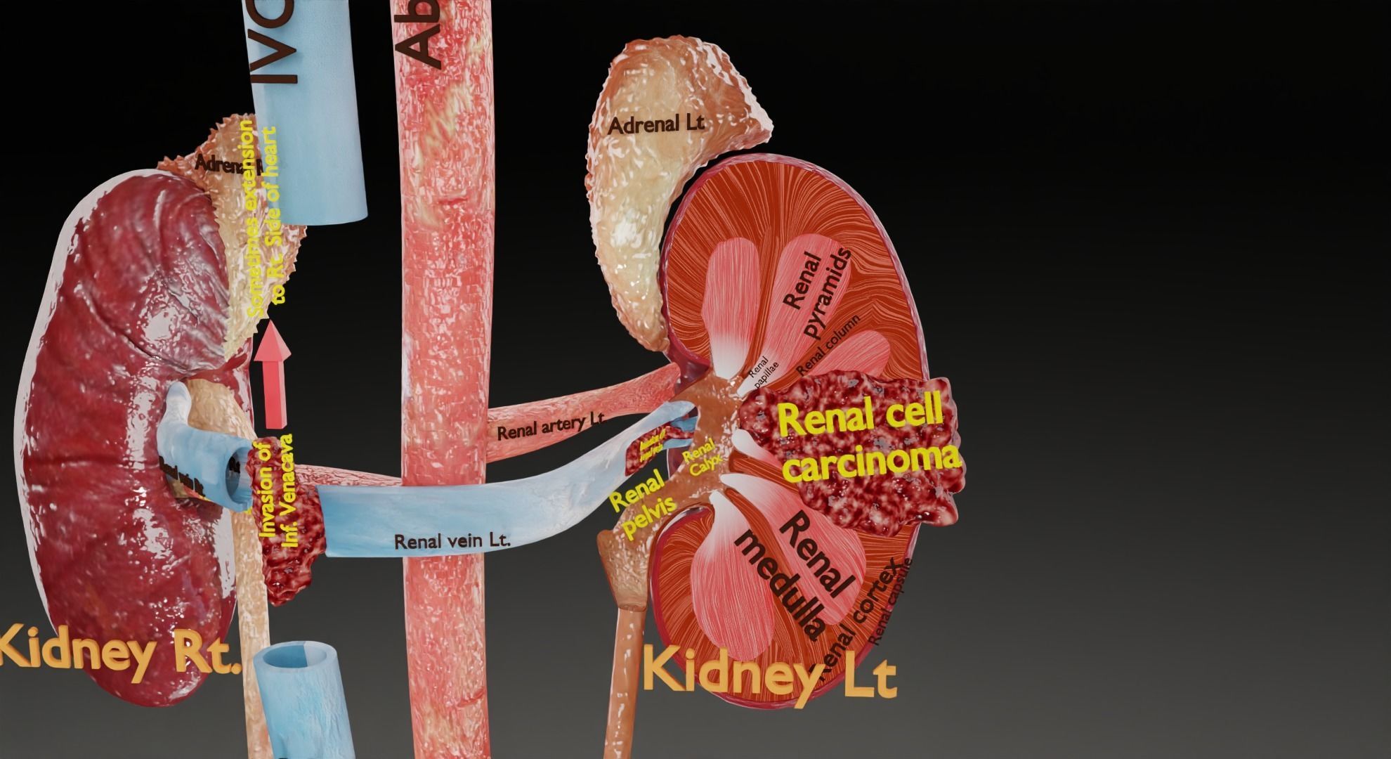 Kidney Cell Model Renal cell carcinoma 3D model animated | CGTrader