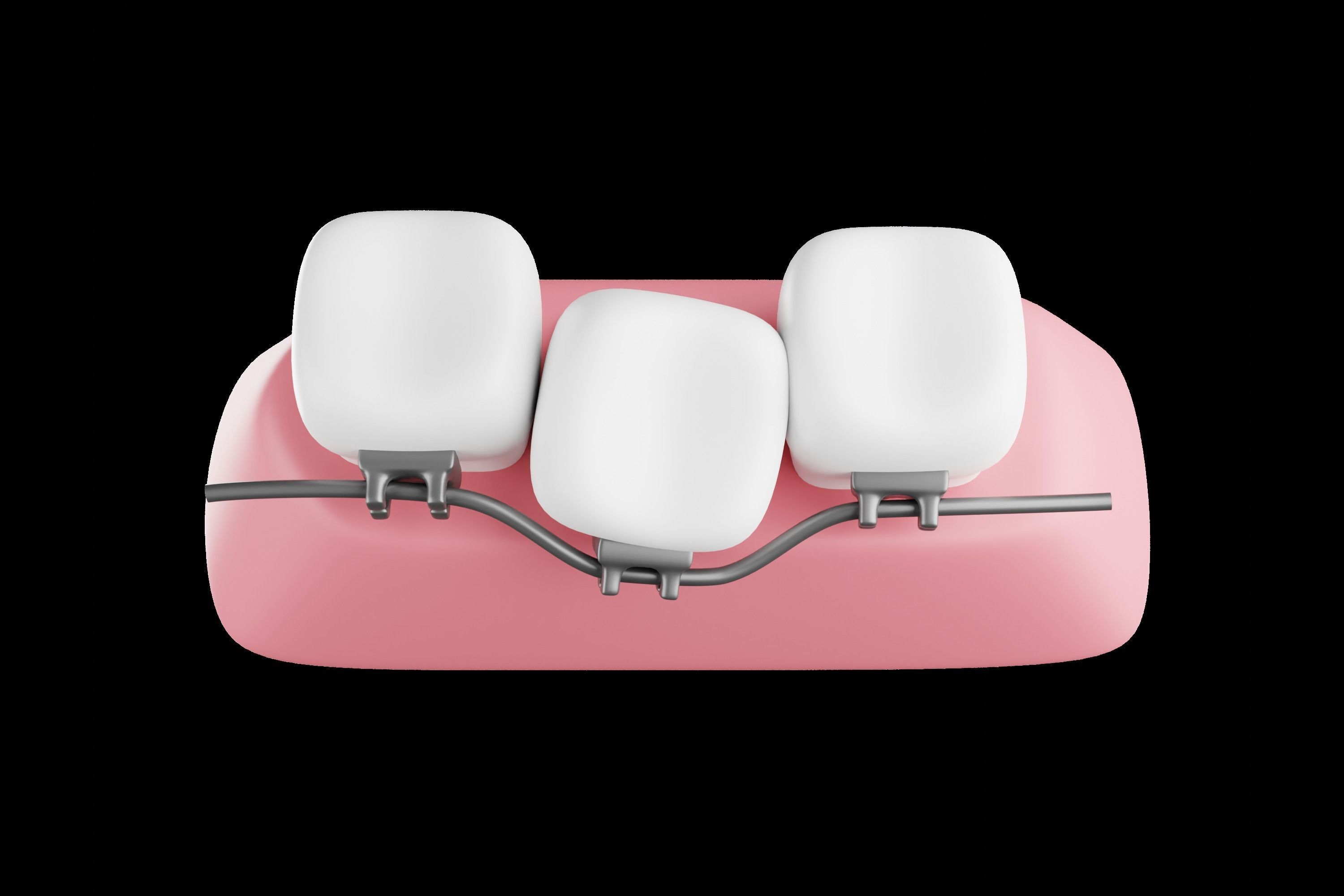 Dental braces system for bite correction 3D model | CGTrader